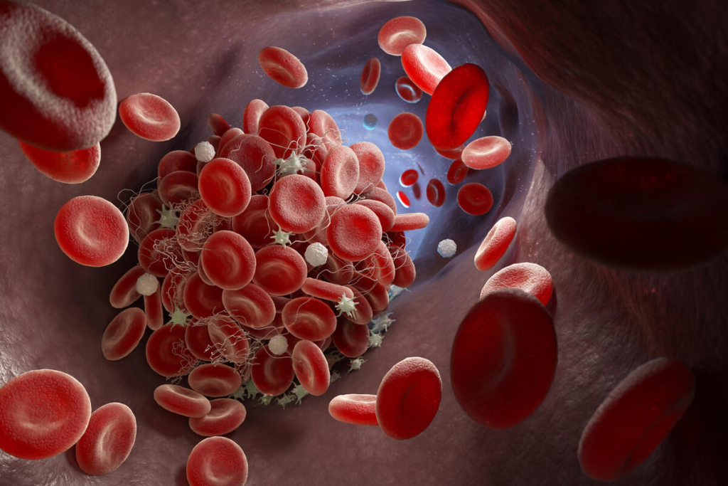 What Causes Blood Clots: Essential Lifestyle Negative Factors