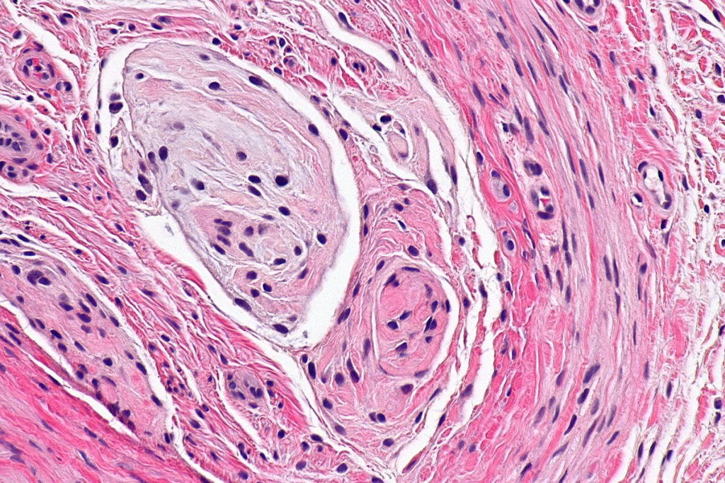 Common Cause Thrombocytopenia Children: Crucial Info