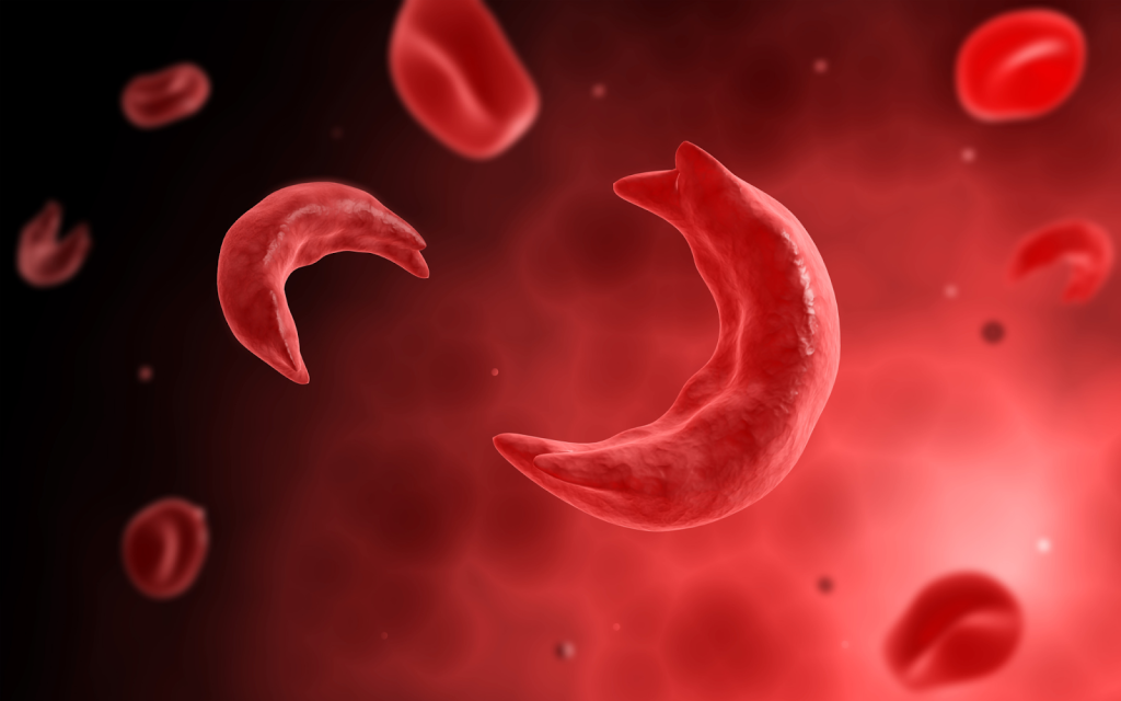 Do White People Get Sickle Cell: Expert Important
