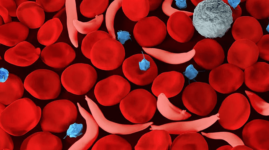 Do White People Get Sickle Cell: Expert Important