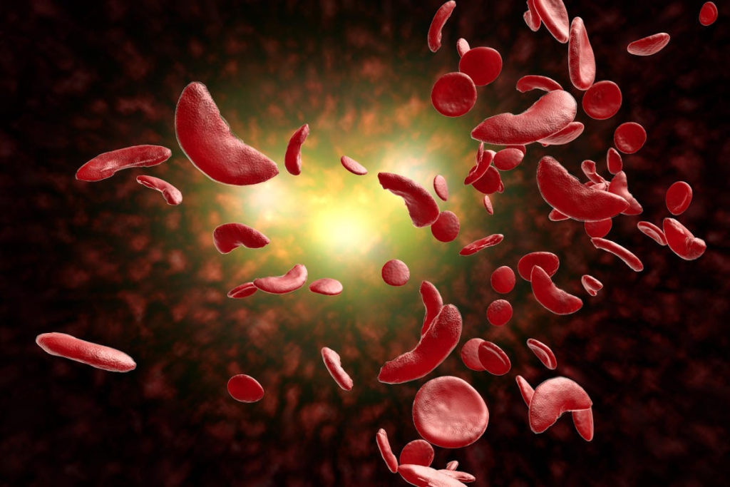 Rare Genetic Results Double Sickle Cell “ Prevention Tips