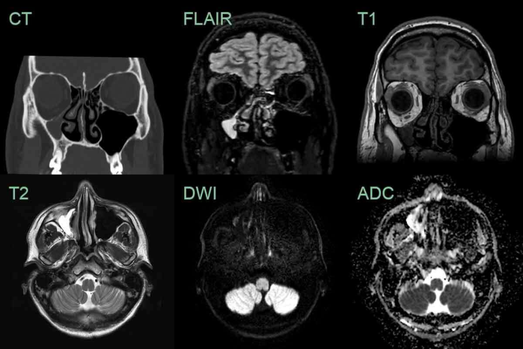 Healthy Sinus CT Scan: Essential Guide to Recognizing Normal
