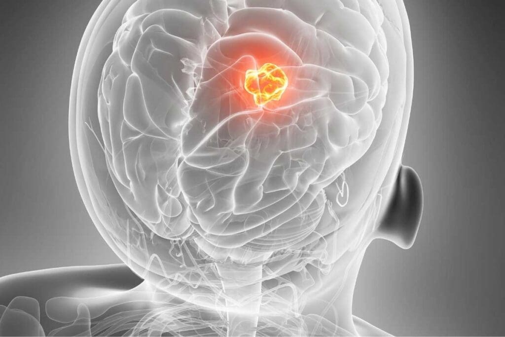 7 Key Facts About Grade 3 Brain Tumor and Its Stages 2 7 Key Facts About Grade 3 Brain Tumor and Its Stages