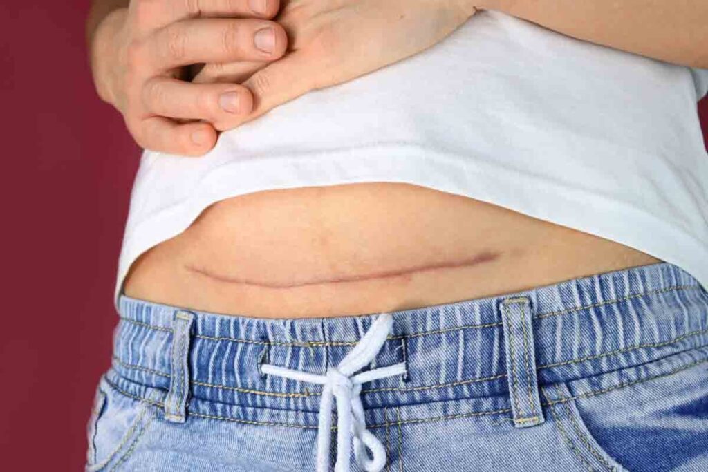 Adhesion Removal: How to Manage This Painful Problem