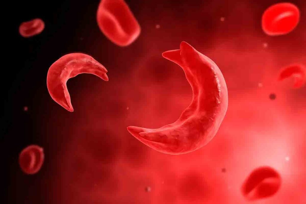 How to Diagnose Sickle Cell Anaemia
