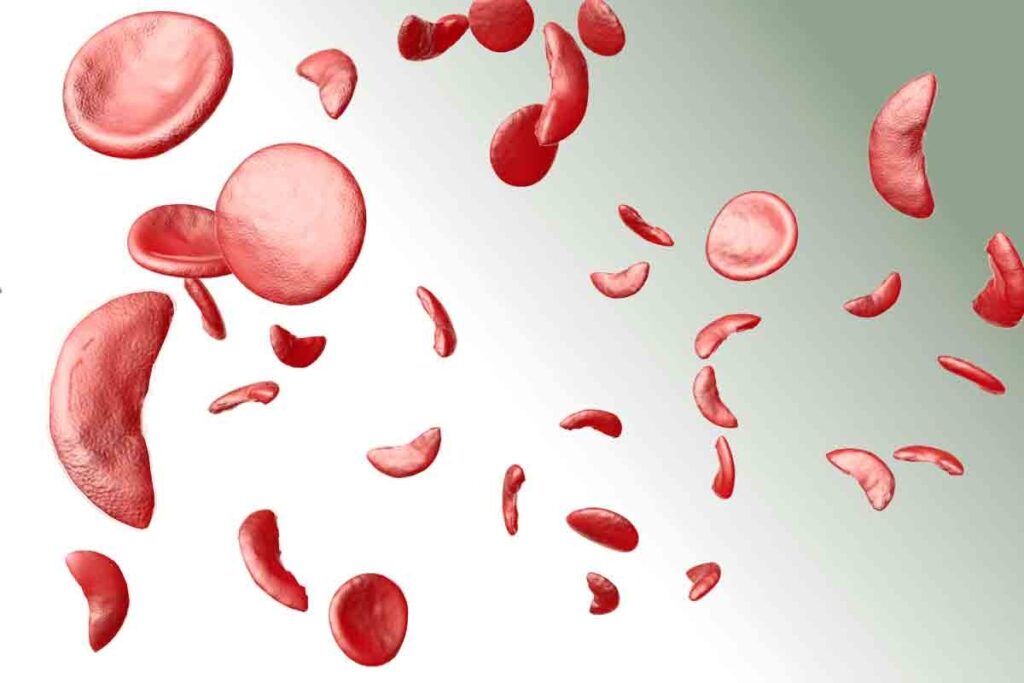 How to Diagnose Sickle Cell Anaemia