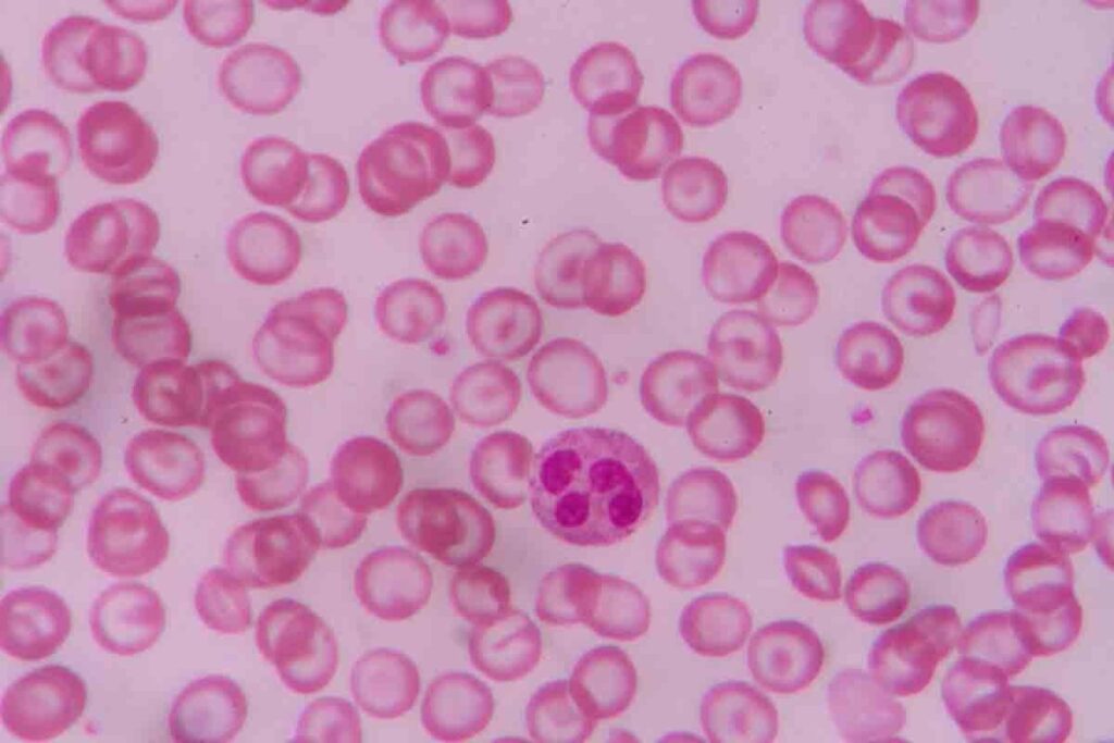 Why Is Sickle Cell Painful?