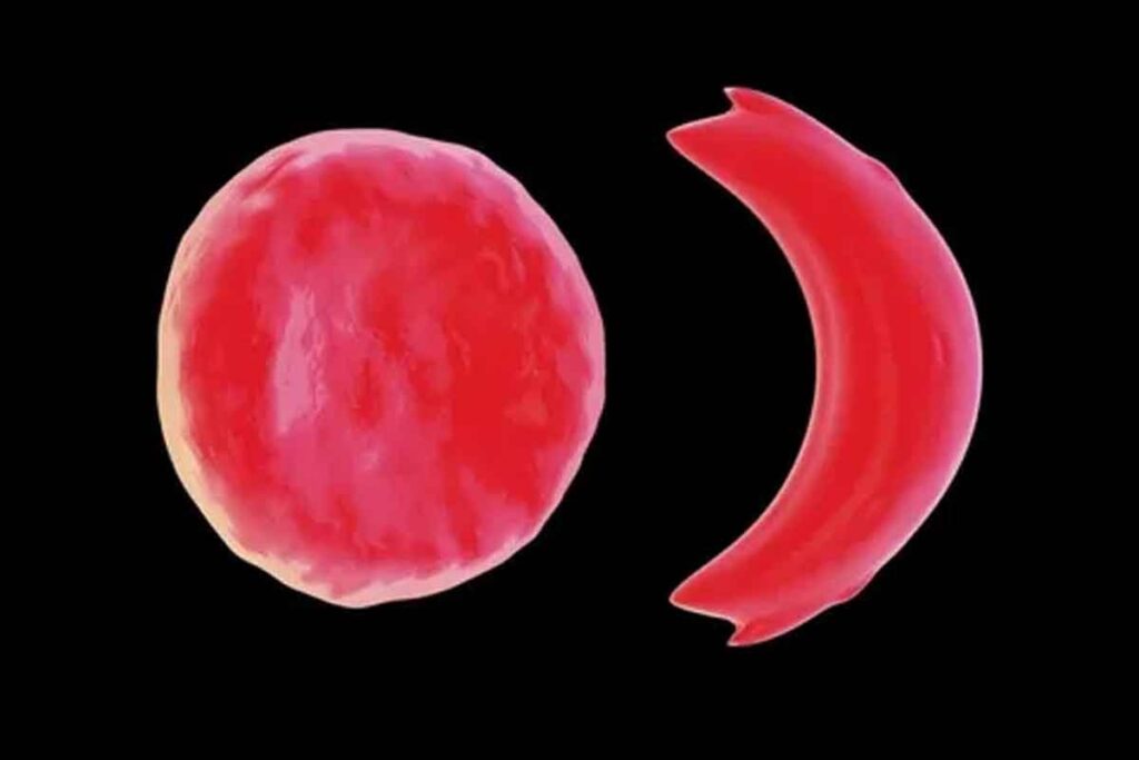 Sickle Cell Trait: Key Facts & FAQs