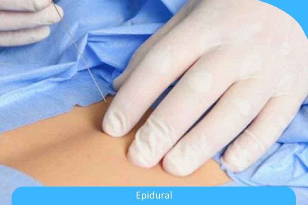 How Long Do Epidural Steroid Injection Side Effects Last