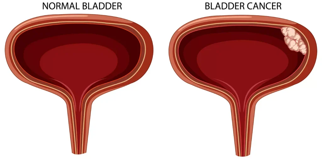 image depicting a normal bladder and one with non-muscle invasive bladder cancer, including papillary, carcinoma in situ, and superficial tumors image depicting a normal bladder and one with non-muscle invasive bladder cancer, including papillary, carcinoma in situ, and superficial tumors