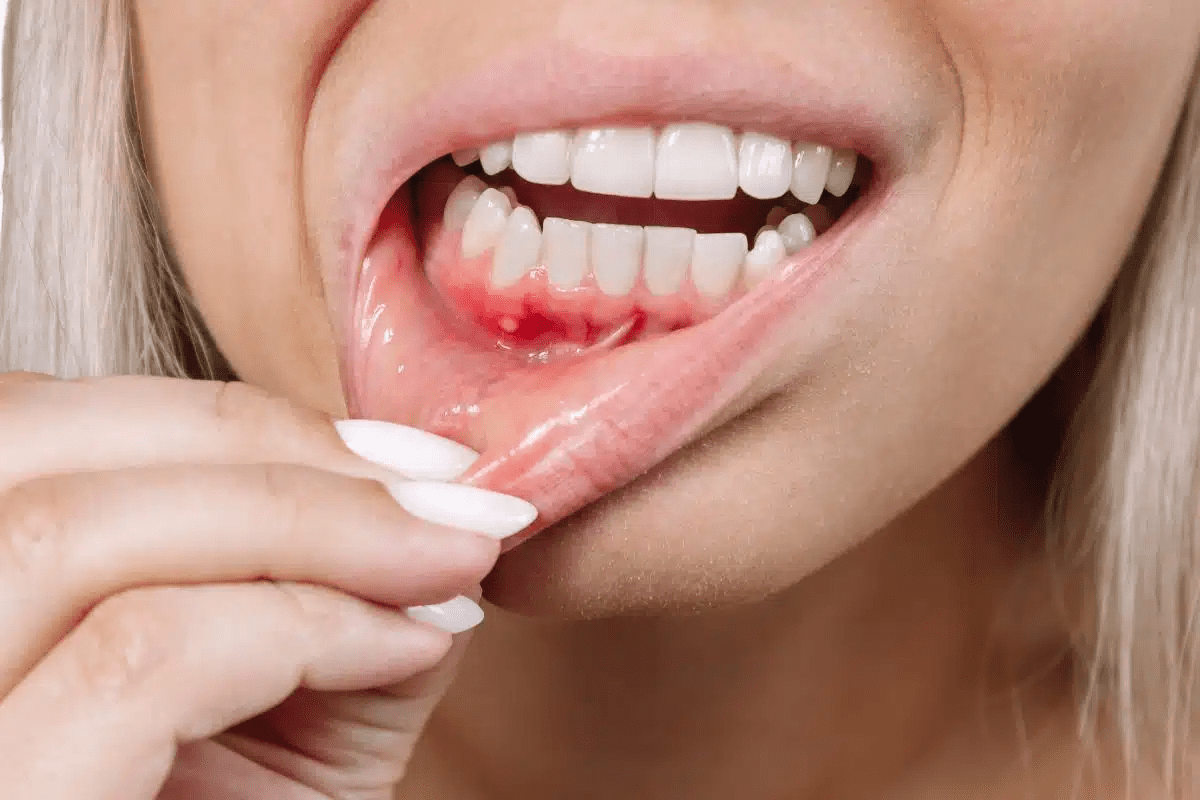Sore Throat Medical Term Explained
