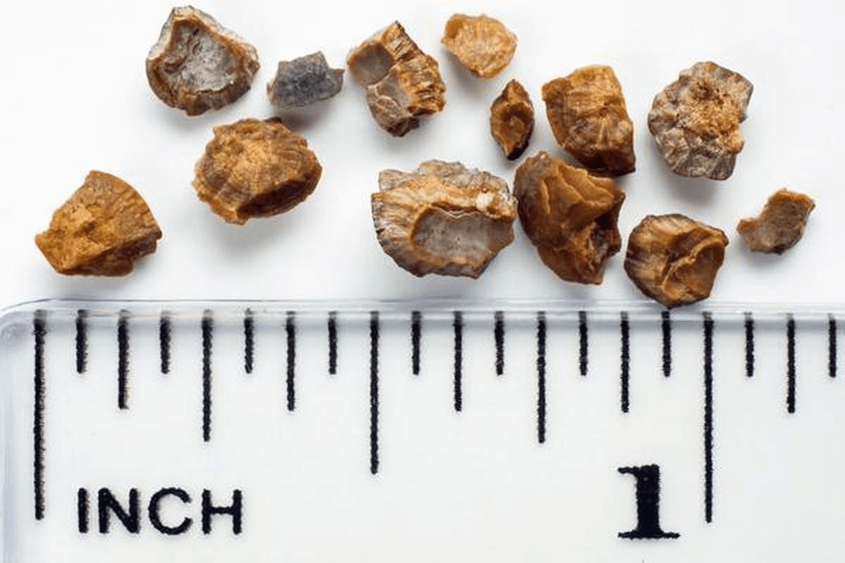 Uric Acid Kidney Stones: Prevention in 5 Steps