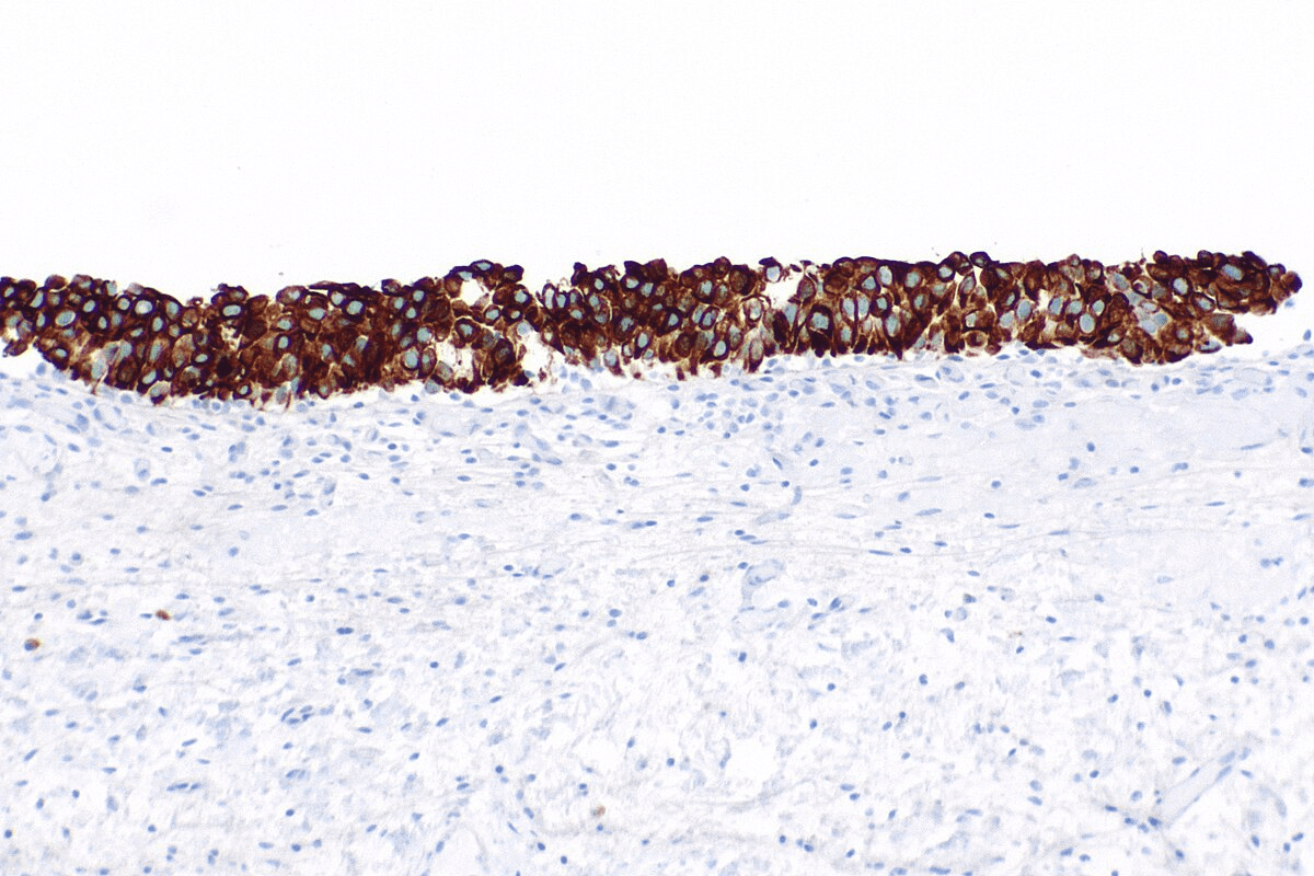 Uric Acid Renal Stones: Causes & Treatment