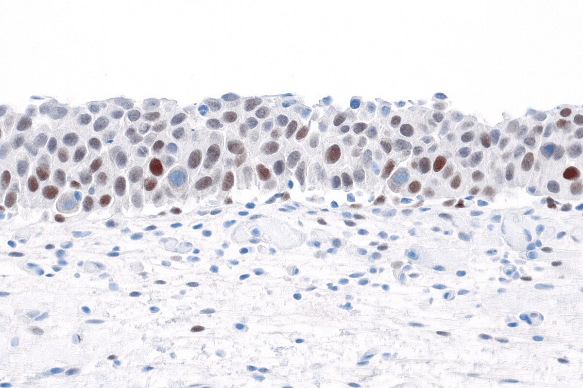 Uric Acid Renal Stones: Causes & Treatment