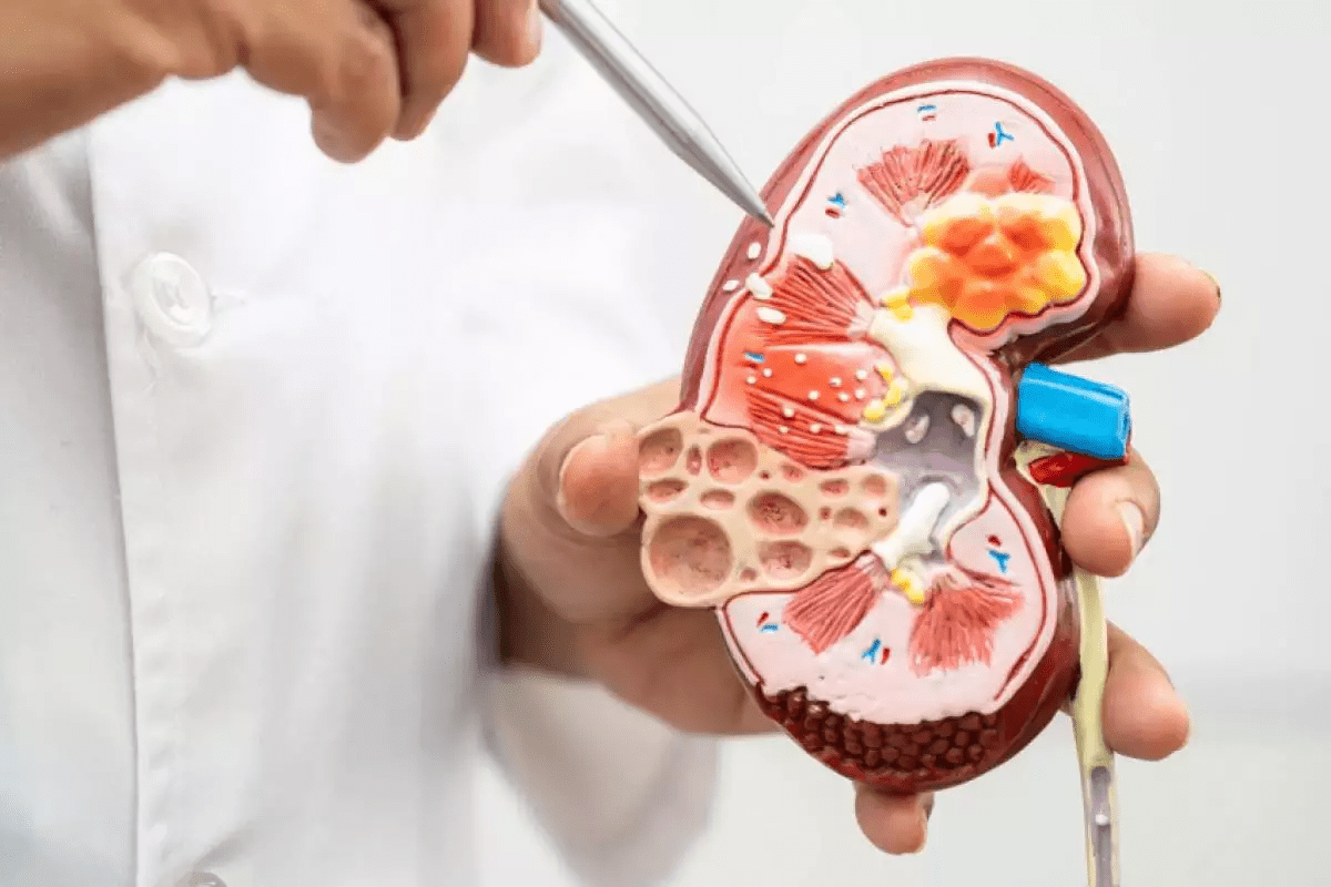 Can Kidney Stones Cause Bloating?