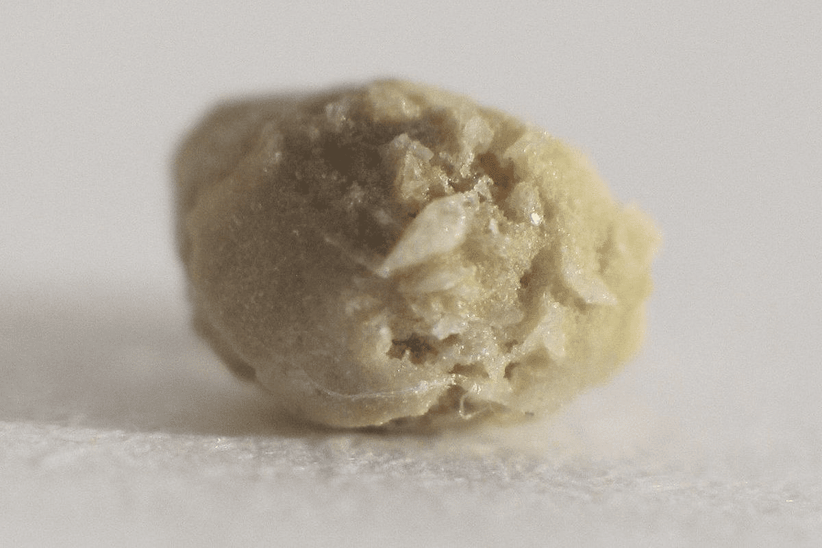 A Stone Found in the Ureter Is Called: Symptoms & Facts