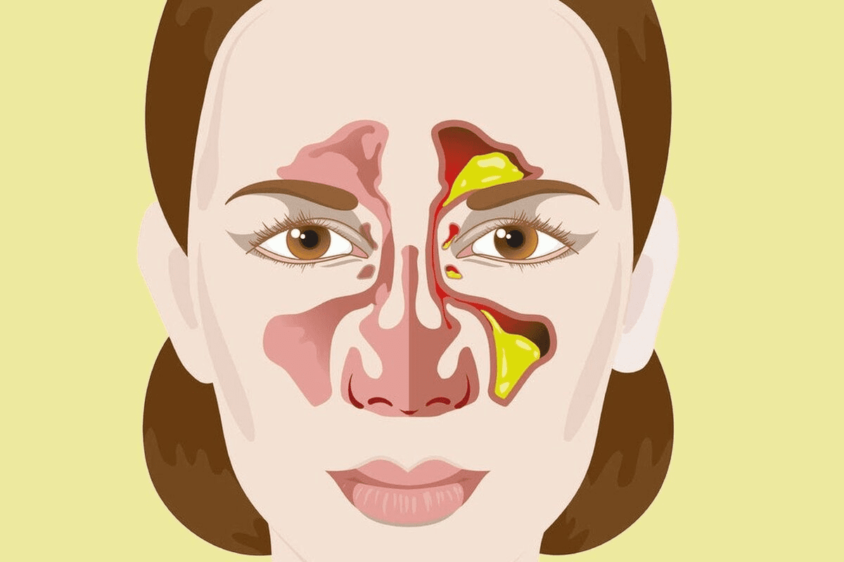 Dry Throat and Nose: Relief for Nasal Passages and Throat