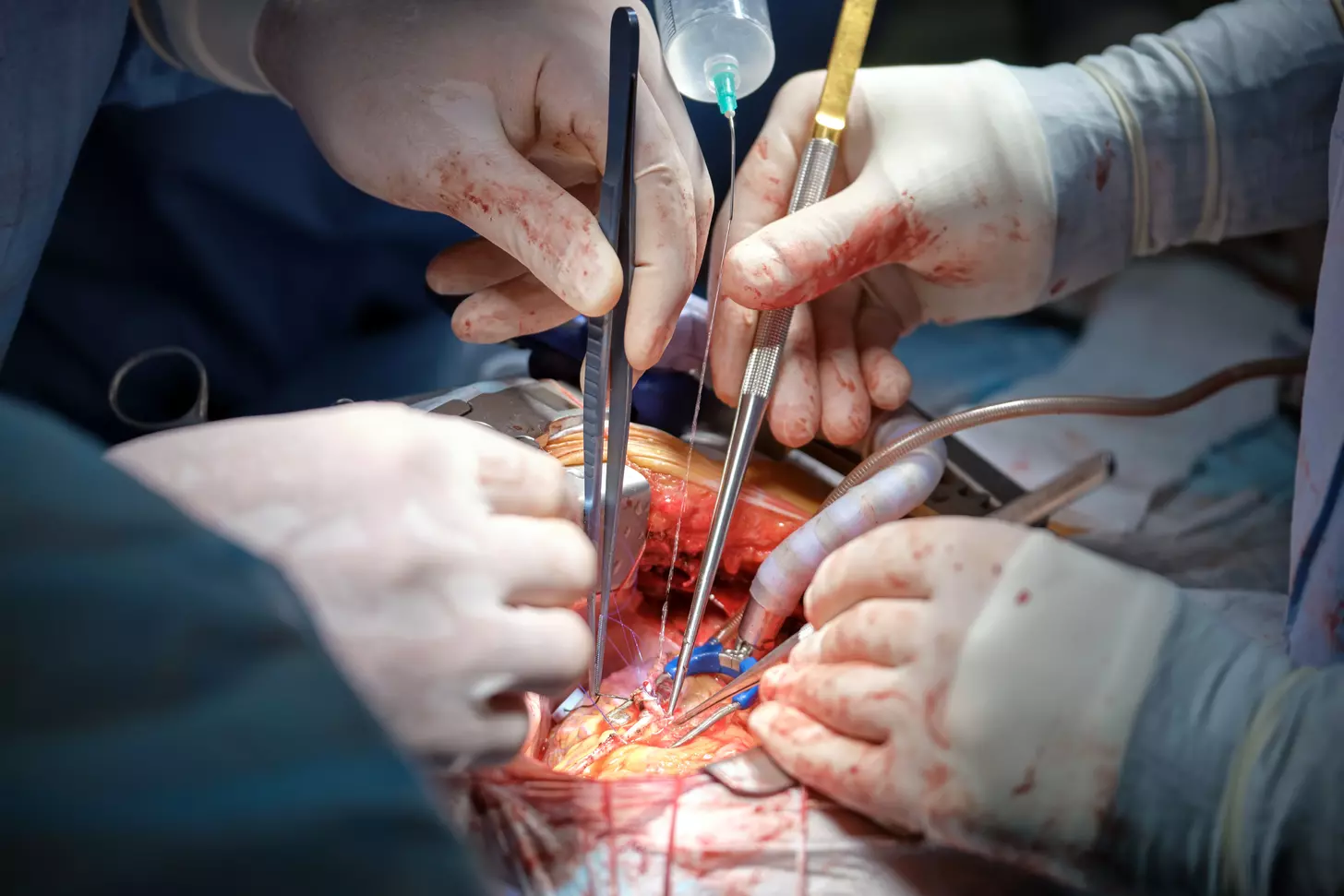 Is CABG Open Heart Surgery? What You Need to Know About Heart Bypass Graft Procedures