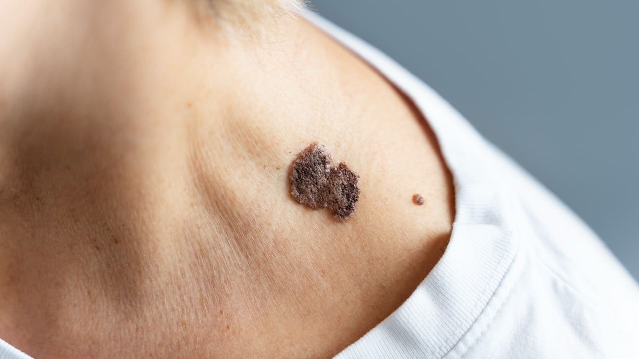 Is Skin Cancer Contagious or Infectious?