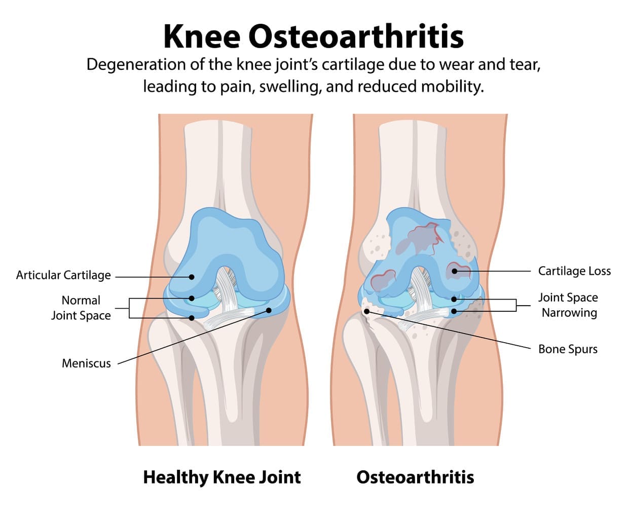 7 Key Causes of Osteoarthritis Knee (Degenerative Joint Disease): Prevention & Management
