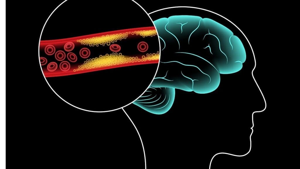 malignant meningioma malignant meningioma
