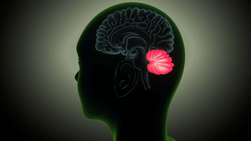 malignant meningioma malignant meningioma