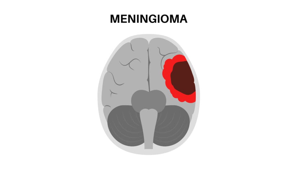 meningioma