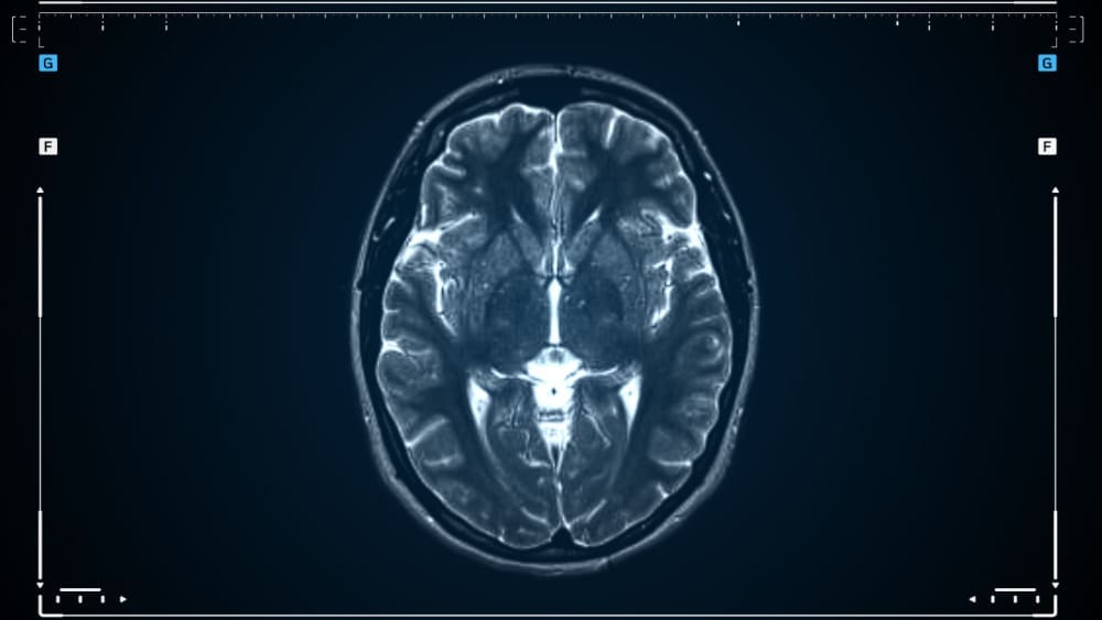 meningioma brain scan meningioma brain scan