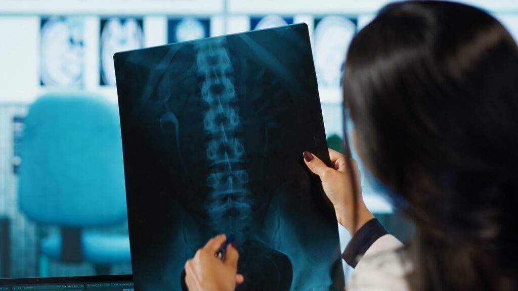 nerve damage during spinal fusion nerve damage during spinal fusion