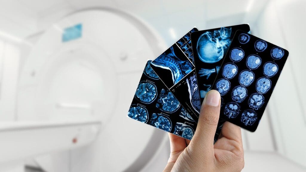 pathophysiology of cerebral infarcts pathophysiology of cerebral infarcts