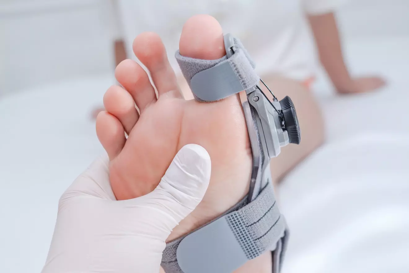 How Long Does It Take to Recover from Minimally Invasive Bunion Surgery?