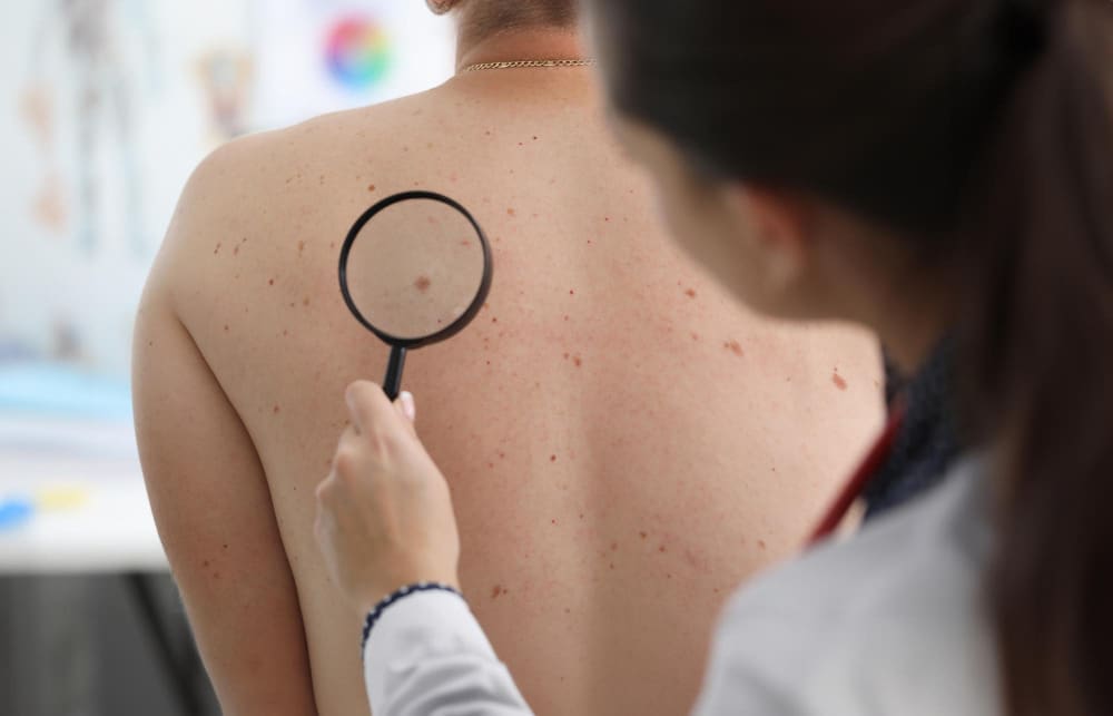 skin cancer diagnosis