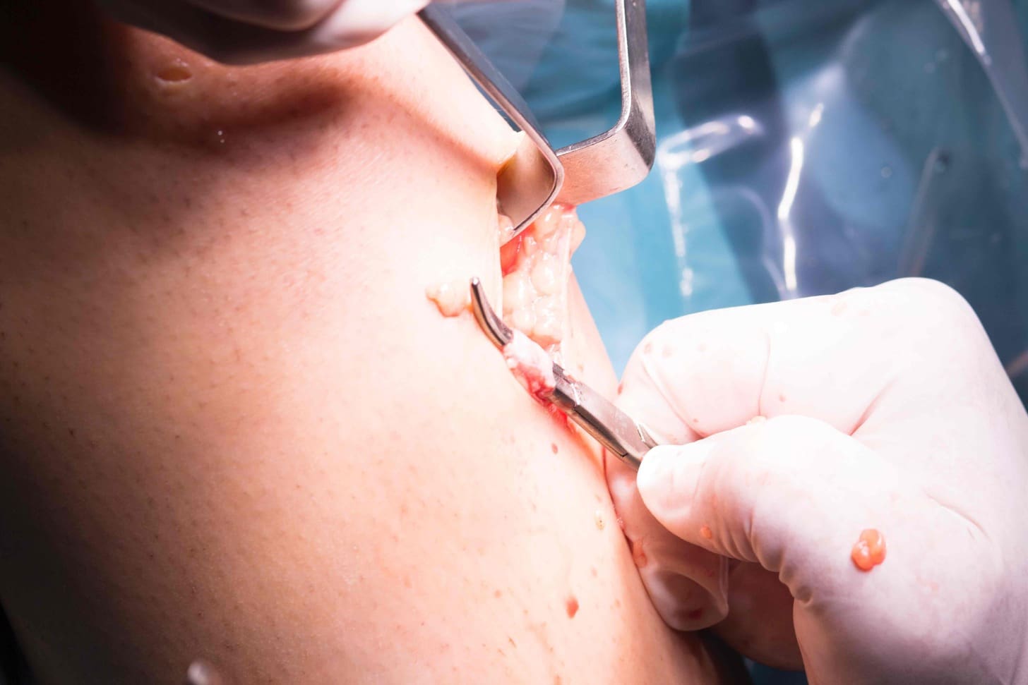 6 Essential Methods for Skin Cancer Surgery: Removal and Treatment Options