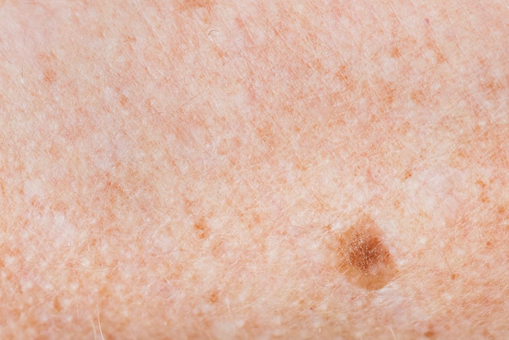 skin nodules skin nodules