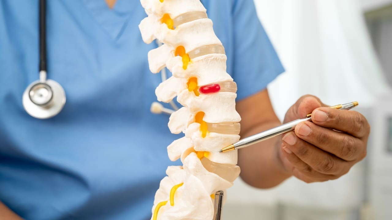 7 Essential Facts About Spinal Arthrodesis: From Fused Vertebrae to Back Fusion Surgery