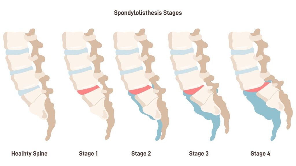 spinal cord injury types spinal cord injury types