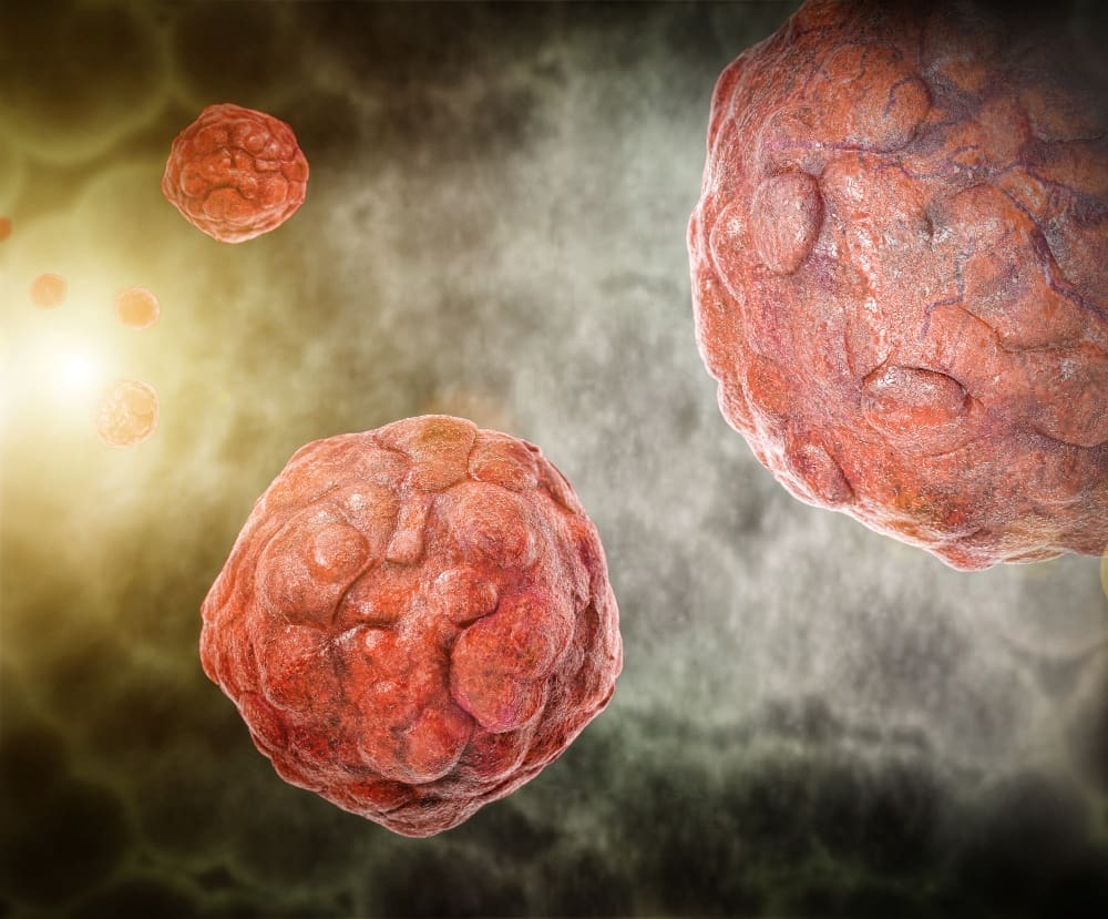 Neoplastic Benign Tumors: Key Facts, Causes, and Symptoms Explained