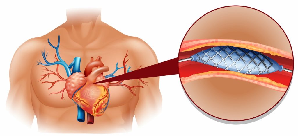 two distinct organ models represent the donor and recipient tissues, connected by a network of blood vessels.  two distinct organ models represent the donor and recipient tissues, connected by a network of blood vessels.