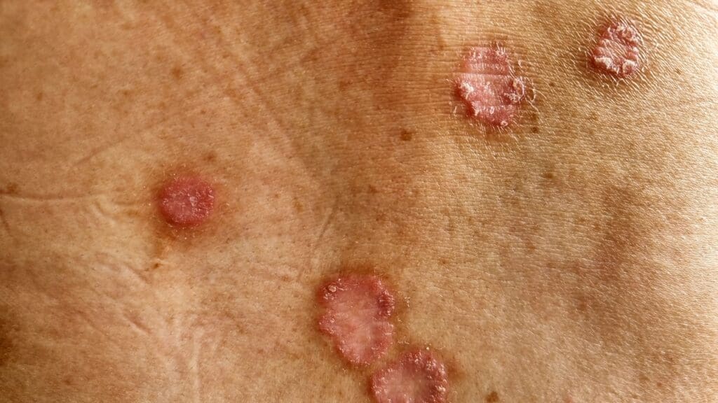 types of skin cancer types of skin cancer