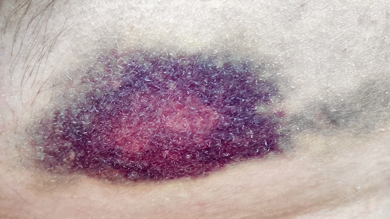 What Is the Manner of Death If It Was Skin Cancer? Understanding 'Natural Causes' Explained