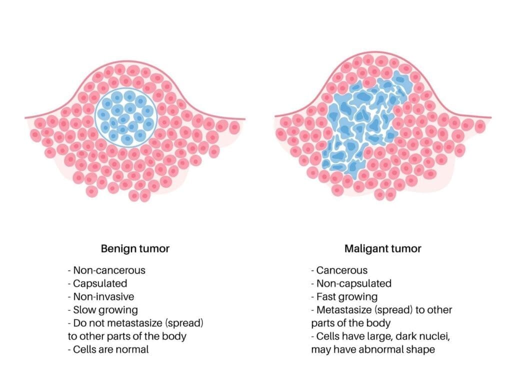 What Is the Difference Between Malignant and Benign Tumors?