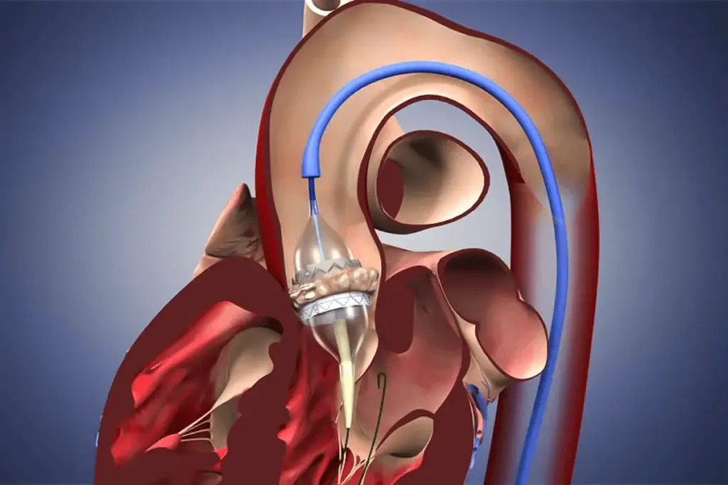 Mitral Replacement Valve: Amazing Success 1 Mitral Replacement Valve: Amazing Success