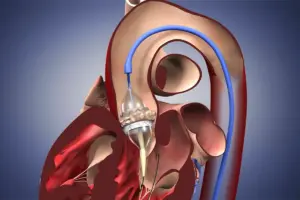 Mitral Replacement Valve: Amazing Success