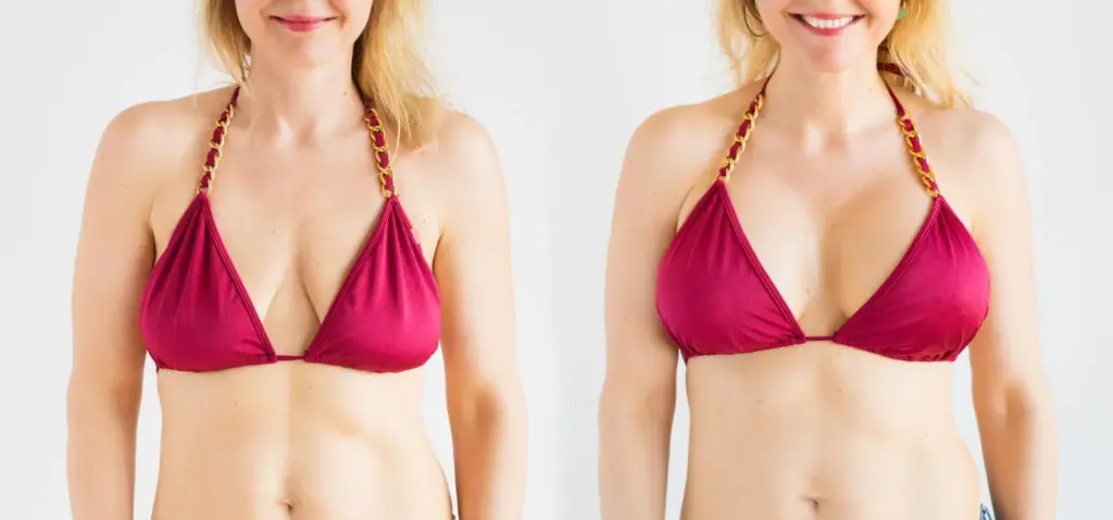 Breast Lift Before and After