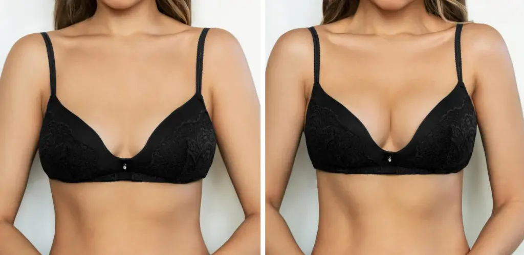 Breast Augmentation Before and After